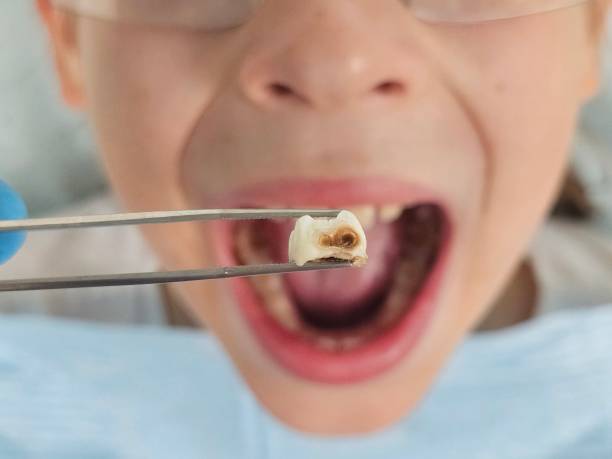 Best Emergency Dental Care for Abscessed Tooth in Tton, IL